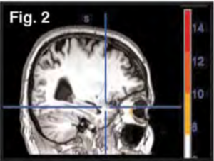 An Observation on Neuro-Emotional Technique's Impact on the Brain after-net-mri-of-brain