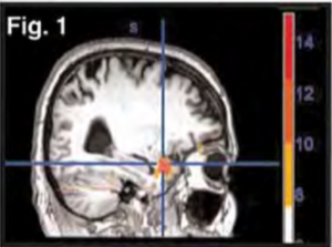 An Observation on Neuro-Emotional Technique's Impact on the Brain unresolved-trauma-MRI